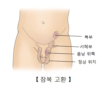 잠복고환증