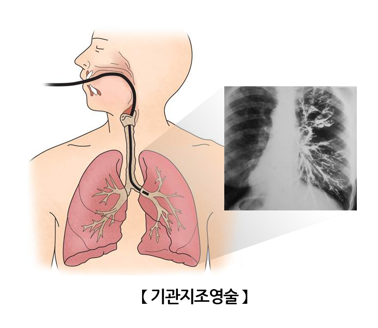 기관지조영술